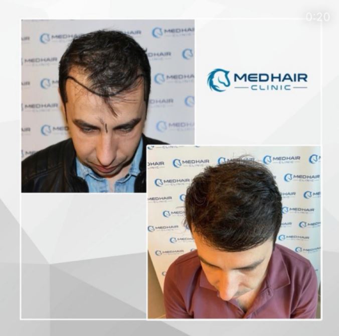 Пересадка волос в Турции
